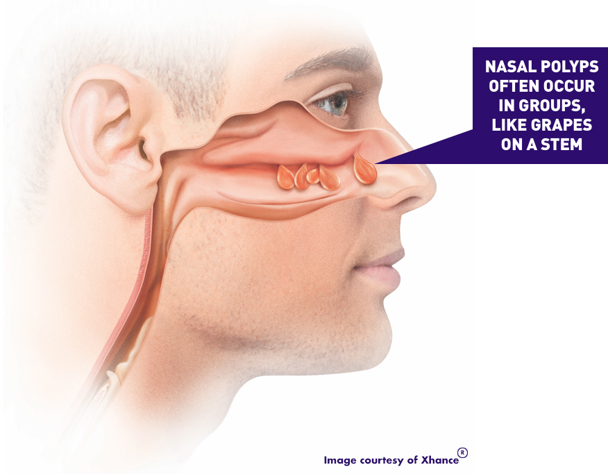 Sinus Disease & Nasal Polyps – The Midwest Sinus Center